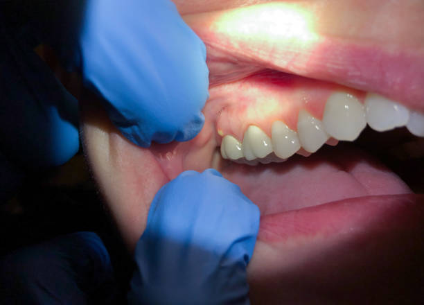Best Broken or Chipped Tooth Repair in Traer, IA